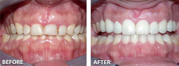 tooth pain after crown lengthening