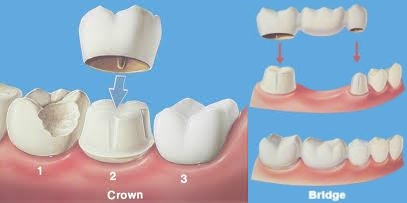 Crowns and Bridges Los Angeles Dentist