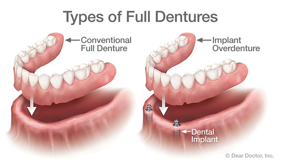 denture type